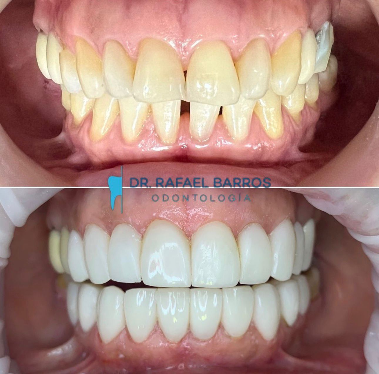 Diseño de sonrisa