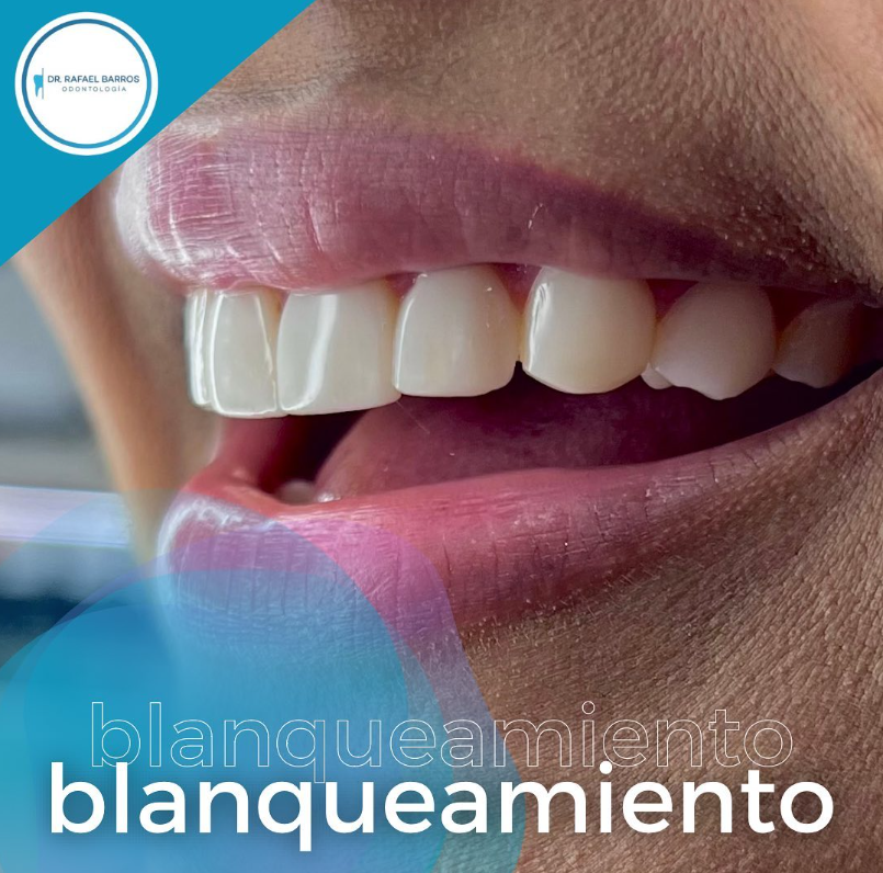 Blanqueamiento dental